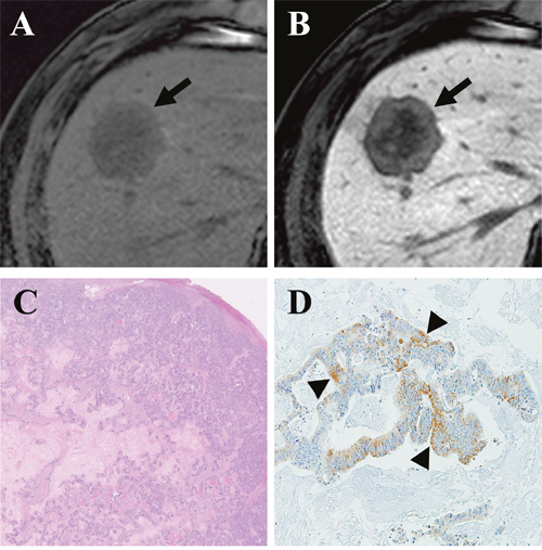 Gadoxetic acid-enhanced MRI of a CRLM diagnosed by surgical resection in a 61-year-old man.