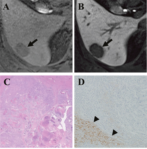 Gadoxetic acid-enhanced MRI of a CRLM diagnosed by surgical resection in a 49-year-old man.