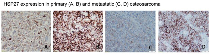 Expression of heat shock protein 27 (HSP27) varies in human osteosarcoma primary tumors and lung metastases.