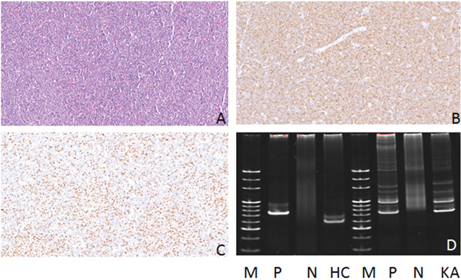 Hematoxylin-eosin (HE), Immunohistochemical staining and IG gene rearrangement of mantle cell lymphomas.
