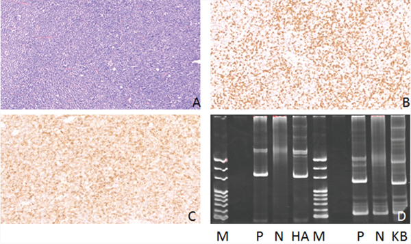 Hematoxylin-eosin(HE), Immunohistochemical staining and IG gene rearrangement of small lymphocytic lymphomas.