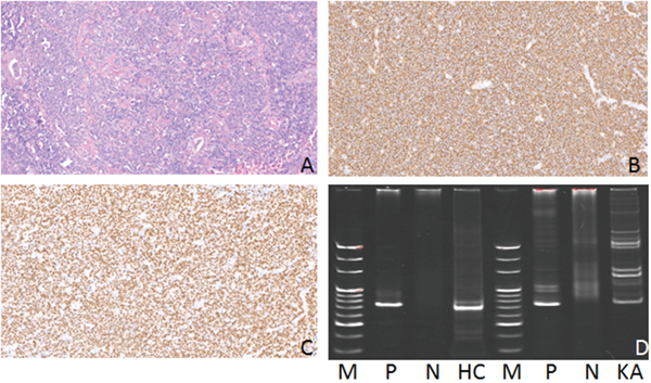 Hematoxylin-eosin(HE), Immunohistochemical staining and IG gene rearrangement of extranodal marginal zone B-cell lymphomas of mucosa-associated lymphoid tissue.
