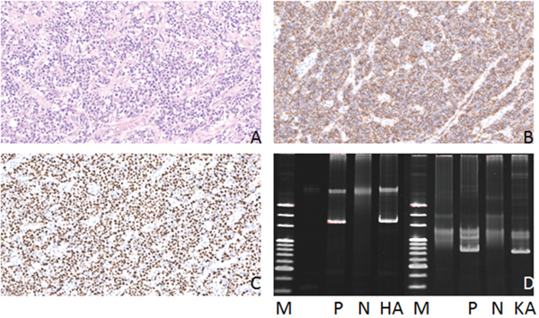 Hematoxylin-eosin(HE), Immunohistochemical staining and IG gene rearrangement of diffuse large B-cell lymphomas.