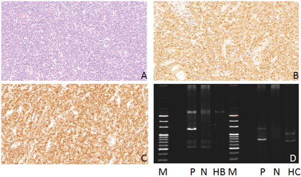Hematoxylin-eosin(HE), Immunohistochemical staining and IG gene rearrangement of lymphoplasmacytoid lymphomas.