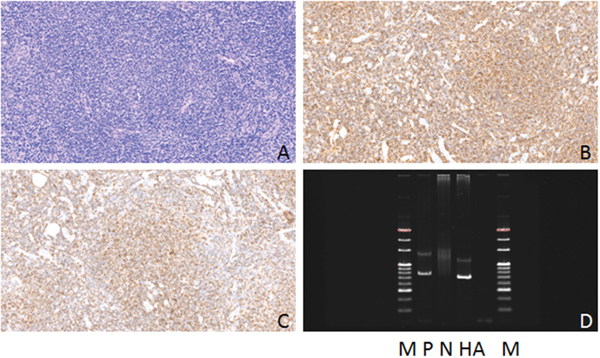 Hematoxylin-eosin(HE), Immunohistochemical staining and IG gene rearrangement of follicular lymphomas.
