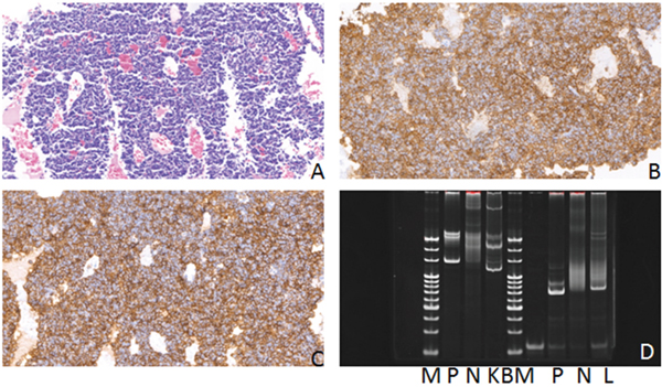 Hematoxylin-eosin(HE), Immunohistochemical staining and IG gene rearrangement of plasmocytomas.
