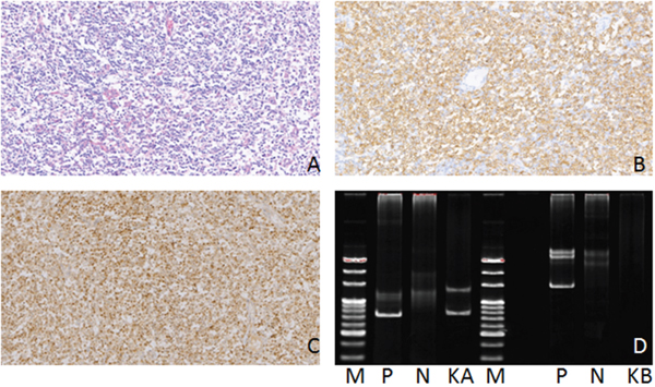 Hematoxylin-eosin(HE), Immunohistochemical staining and IG gene rearrangement of nodal marginal zone B-cell lymphomas.
