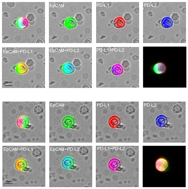 Fluorescence co-localization of EpCAM (green), PD-L1 (red) and PD-L2 (blue) on the CETCs in two representative results.