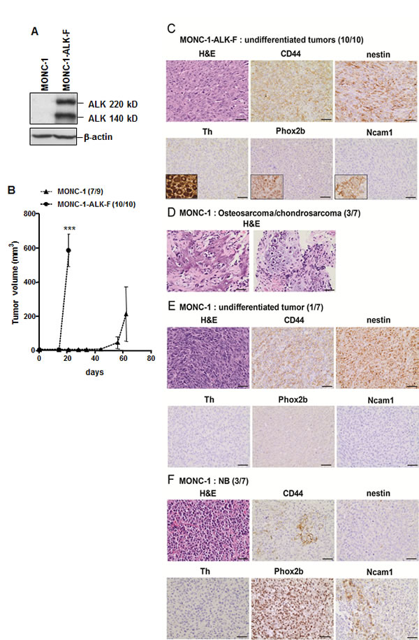 ALK-F1174L impairs differentiation of MONC-1-derived tumors.