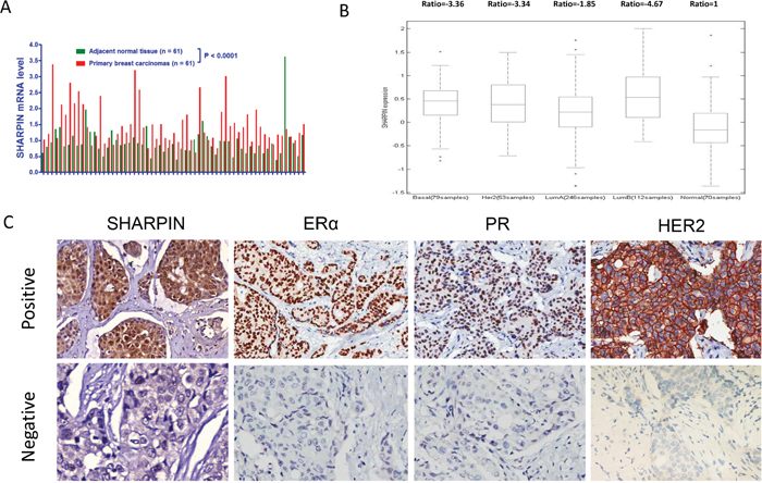 SHARPIN is higher expressed in breast tumor, correlates with ER &#x03B1; protein level in breast tumors.