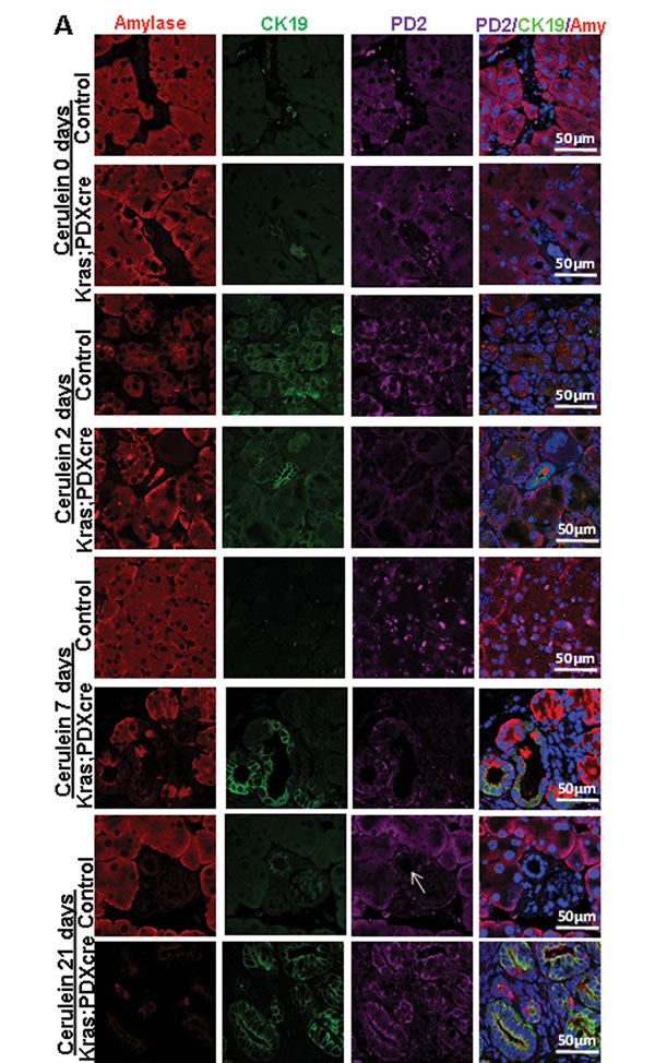 PD2/Paf1 expression during cerulein induced pancreatic injury in normal versus KC mice.