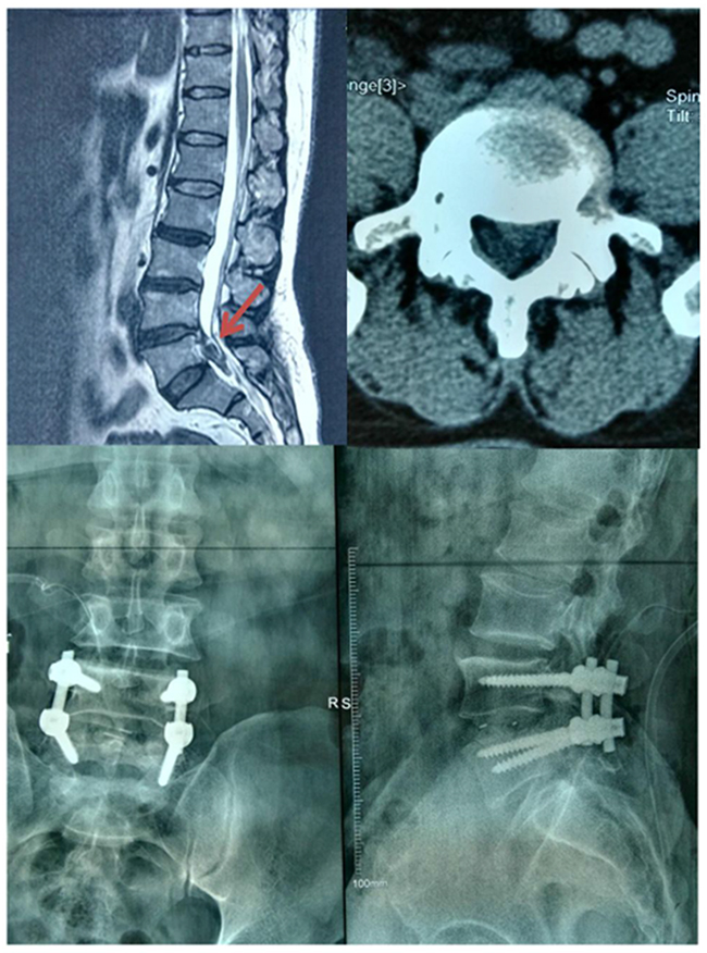 The prolapsed disc was removed from spinal canal after an emergency operation performed.