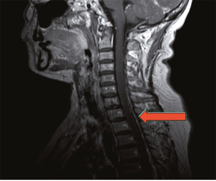 Magnetic resonance image of the same patient.