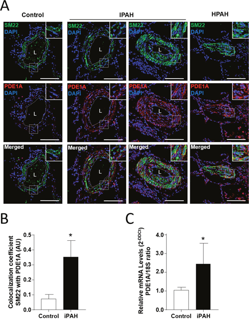 The augmentation of PDE1A expressions in pulmonary arterial smooth muscle cells (PA-SMCs) from patients with I/HPAH.