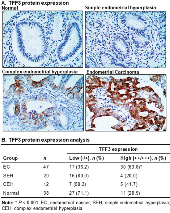High TFF3 expression is observed in EC patient tissue specimens.