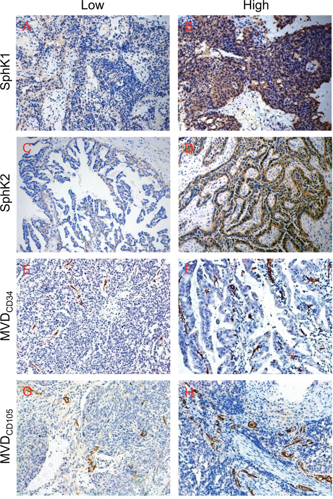 Immunohistochemical staining of SphK1, SphK2, CD34 and CD105 in epithelial ovarian cancer tissues.