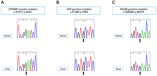 Sanger validation of the variants detected by whole exome sequencing.