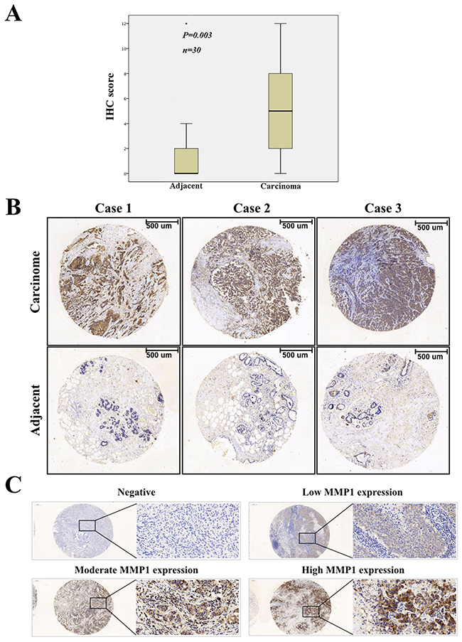 Immunohistochemical staining of MMP1 protein in BC.