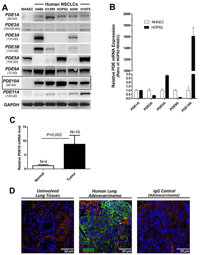 PDE10 overexpression in human lung tumor cells.