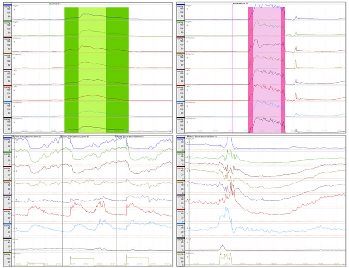 Anorectal manometry evaluation graph.