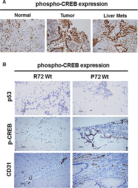 CREB expression in CRC by IHC.