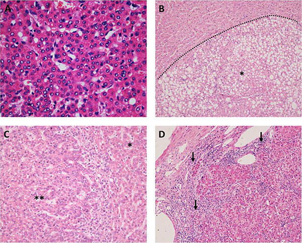 The histomorphological changes of HGDNs and WD-SHCCs (hematoxylin-eosin staining).