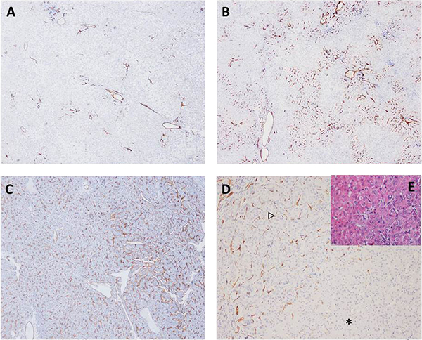 The classifications of sinusoid capillarization (SC) and immunohistochemical staining of CD34.