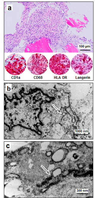 Histology, Immunophenotype and Ultrastructural Findings in Patient HX 36.