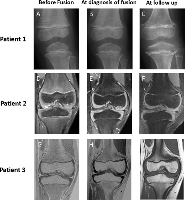 Imaging of knee in patients 1, 2, and 3 before fusion, at diagnosis of fusion, and at follow up.