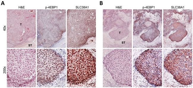 Frequent concomitant activation of mTORC1 and SLC38A1 in human hepatoblastoma.