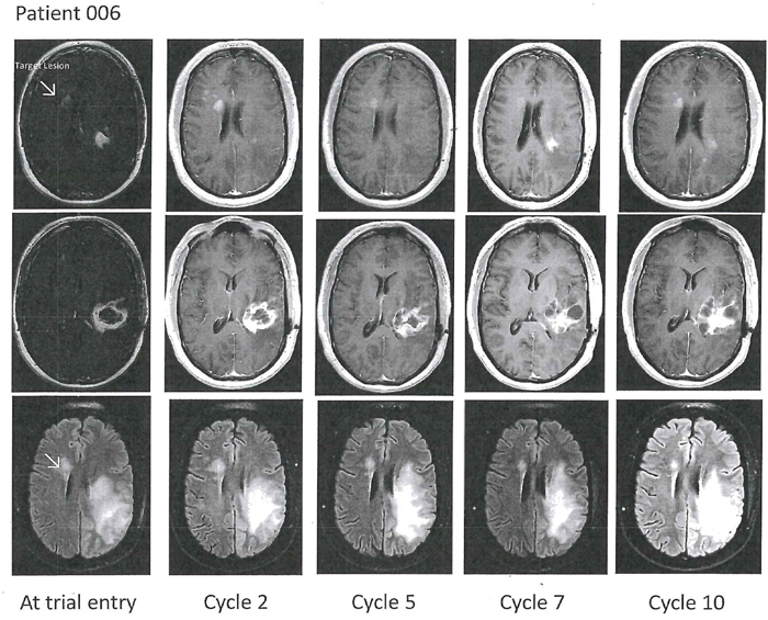 Axial T1-weighted contrast enhanced (top two rows) and T2-FLAIR images (bottom row) in Patient 6 with an original left temporal glioblastoma as depicted in the middle row.