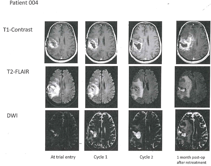 Axial T1-weighted contrast-enhanced images (top row) in Patient 4 with right temporal glioblastoma at trial entry with corresponding T2-FLAIR (middle row) and corresponding DWI with apparent diffusion coefficient (ADC) sequences (bottom row).