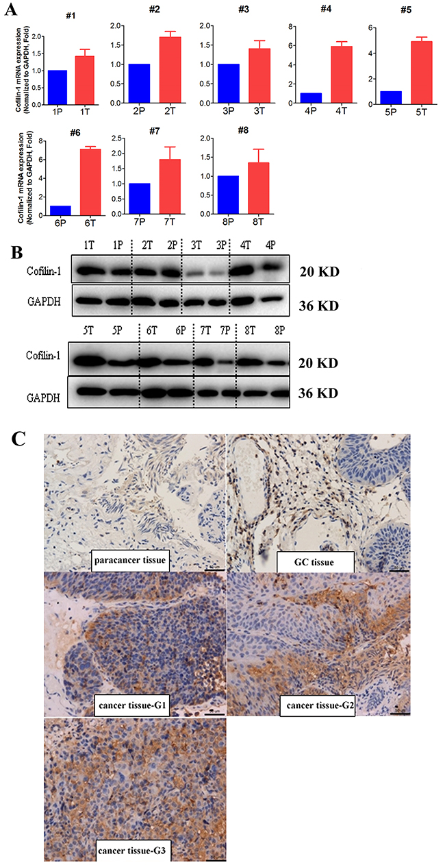 Cofilin 1 expression in bladder cancer and corresponding paracancerous tissues.