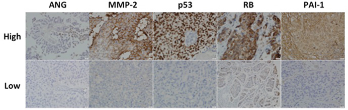 Representative expression status for ANG, MMP-2, p53, RB and PAI-1 in a high-grade non-muscle invasive bladder cancer.