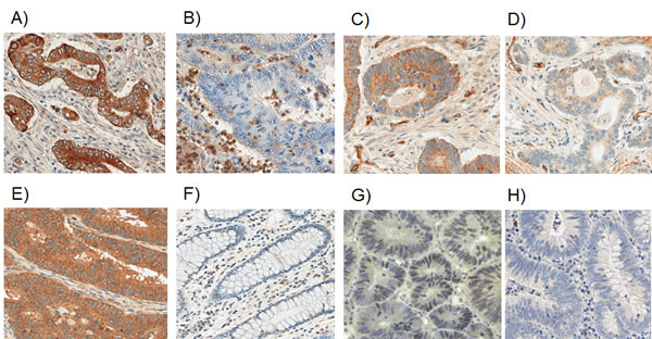 Representative photomicrographs of positive/high (A, C, E, G) and negative/low expression (B, D, F, H) of A-B: IL-23 poly; C-D: IL-23p40; E-F: IL-23R and G -H: IL-23p19.