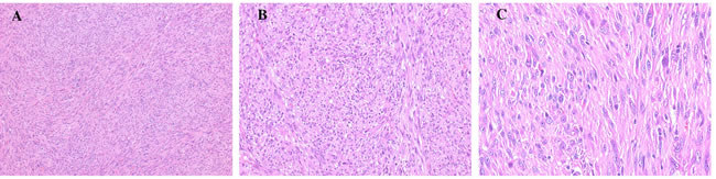 Histology of cardiac undifferentiated IS of this patient composed of spindle and pleomorphic cells