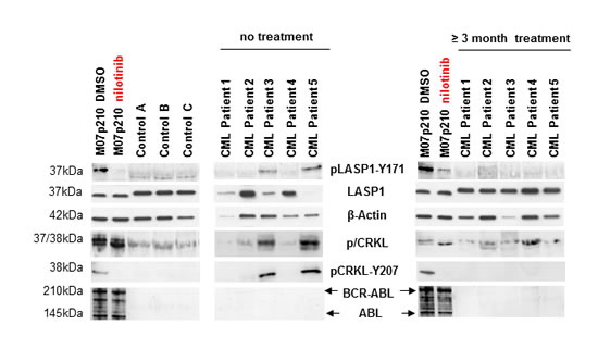 LASP1 is phosphorylated in CML patients.