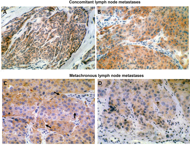 HER-3 expression in human metastatic melanoma.