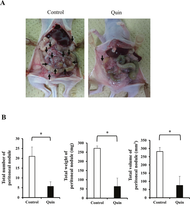 Effects of blockade of potassium ion transports during hypotonic stimulation on the formation of peritoneal metastases of MKN45 cells in nude mice.