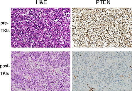 Immunohistochemical (IHC) analysis of hematoxylin and eosin (H&#x0026;E) staining and phosphatase and tensin homolog (PTEN) in original patient GIST-RX1 samples.