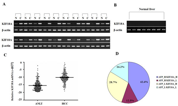 Expression pattern of KIF18A in HCC specimens and normal livers at mRNA levels.