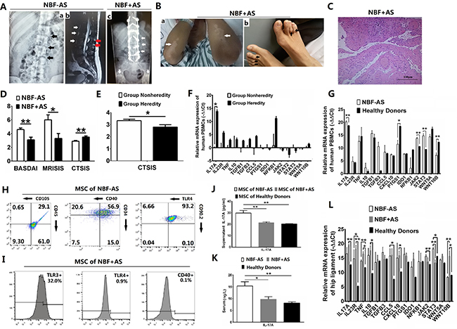 IL-17A-promoted MSC2 polarization related with new bone formation of AS patients.