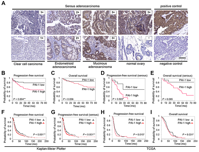 PAI-1 expression correlates with poor prognosis in patients with ovarian cancer.
