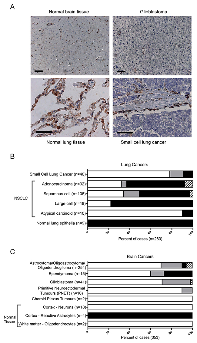 Frequency of NAPRT staining in human lung and brain cancers.