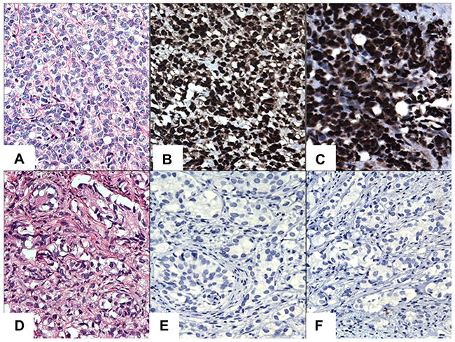 IHC staining of STAT3/5A in CRPC cases.