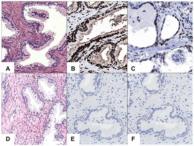 IHC staining of STAT3/5A in BPH cases.