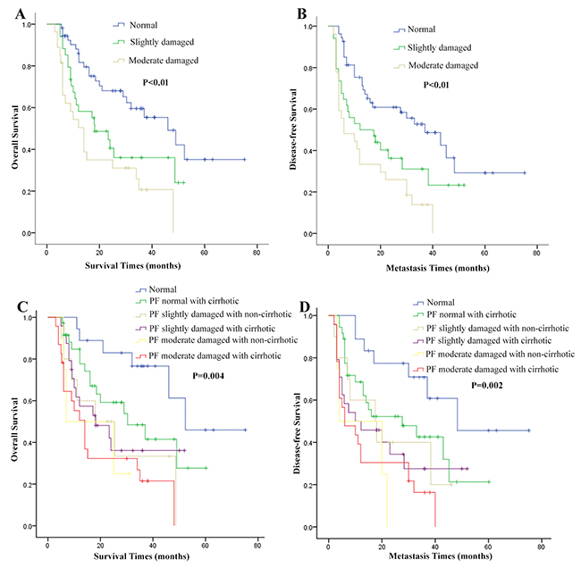 Overall survival (OS) and disease-free survival (DFS) curves in hepatocellular carcinoma (HCC) patients with different pulmonary function (PF) and combined cirrhotic or not.