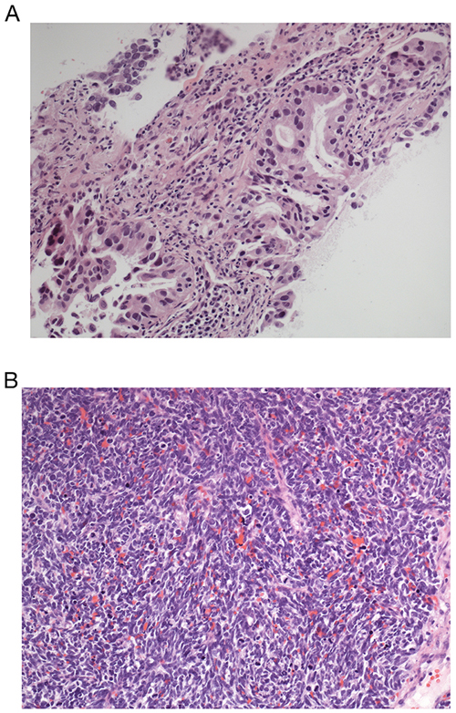 HE stains of endobronchial biopsies of patient 7 (Figure 4).