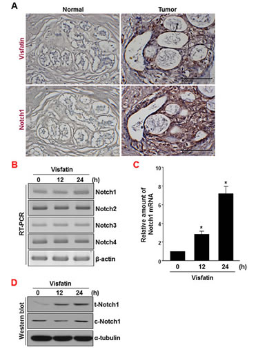 Analysis of visfatin and Notch1 expression in human breast tumor specimens.