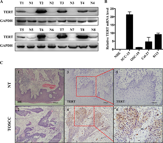 hTERT expression in squamous cell carcinoma tissues and cell lines.
